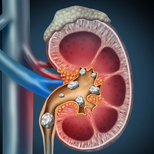 سنگ کلیه چیست؟