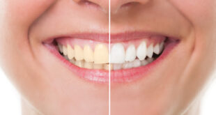 ترفند‌‌های طبیعی برای سفید کردن دندان‌ها