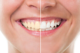 ترفند‌‌های طبیعی برای سفید کردن دندان‌ها