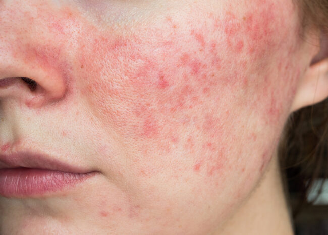 پوست‌های حساس به دلیل حساسیتی که دارند مستعد جوش، قرمزی و التهاب هستند برای همین مراقبت از پوست‌های حساس خیلی مهم است