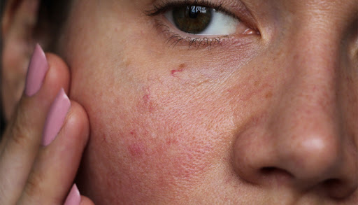 پوست حساس یکی از انواع پوست