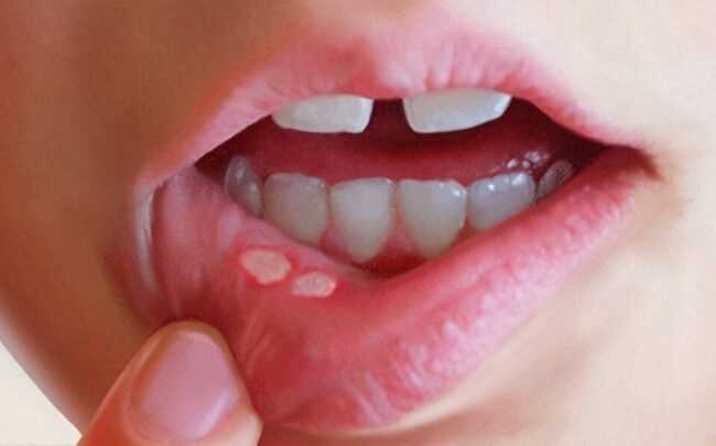 آفت دهان و مشکلات لثه یکی از تاثیرات دیابت بر سلامت دهان و دندان